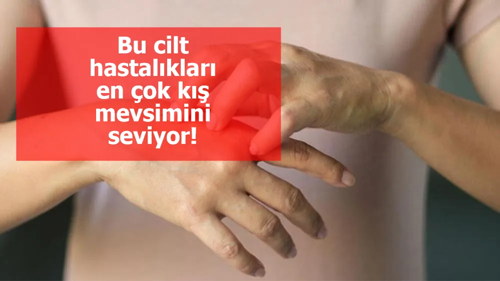 Bu cilt hastalıkları en çok kış mevsimini seviyor!