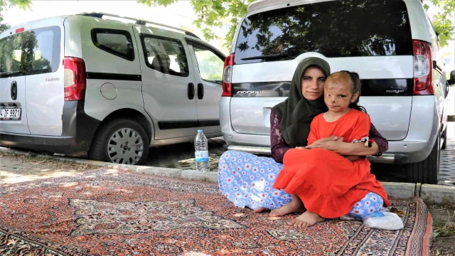 Yangında yüzü yanan Dilara’nın annesi: “Allah razı olsun Sağlık Bakanlığından, kızımın ameliyatını karşılıyor”